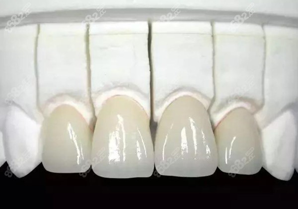 二氧化锆全瓷牙价格揭秘，小巷深处的隐秘宝藏